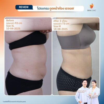 รีวิวดูดไขมันหน้าท้อง 12