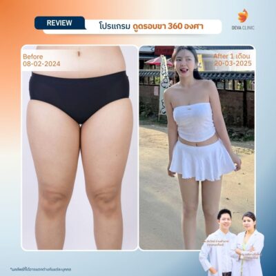 รวมรีวิวดูดไขมันต้นขา 10