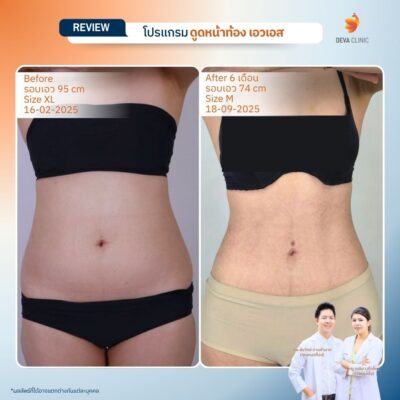 รีวิวดูดไขมันหน้าท้อง 13