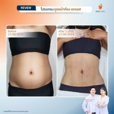 รีวิวดูดไขมันหน้าท้อง 2