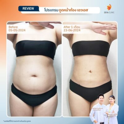 รีวิวดูดไขมันหน้าท้อง 5