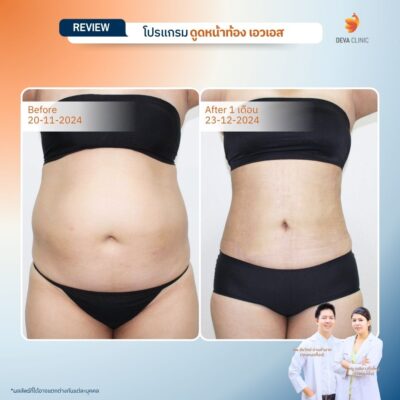 รีวิวดูดไขมันหน้าท้อง 1