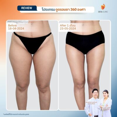 รวมรีวิวดูดไขมันต้นขา 15