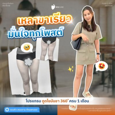 รีวิวดูดไขมันต้นขาทางบ้าน 1