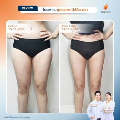 รวมรีวิวดูดไขมันต้นขา 17