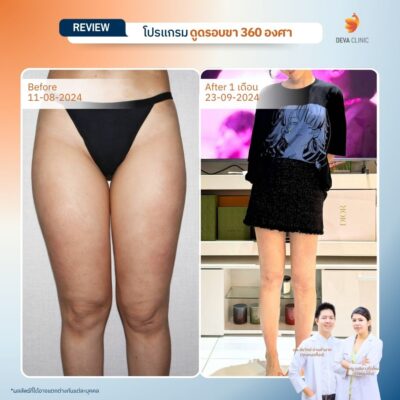 รวมรีวิวดูดไขมันต้นขา 1