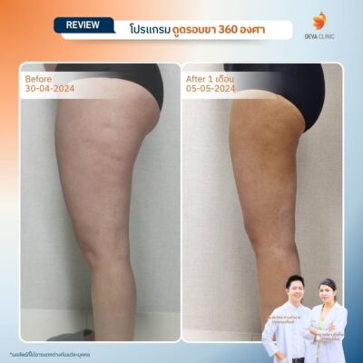 รวมรีวิวดูดไขมันต้นขา 20