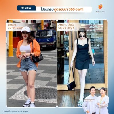 รวมรีวิวดูดไขมันต้นขา 4