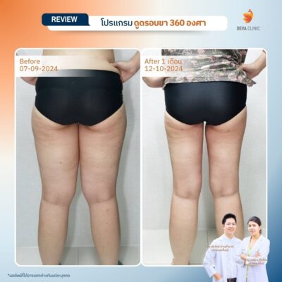 รวมรีวิวดูดไขมันต้นขา 18