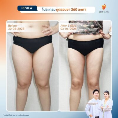 รวมรีวิวดูดไขมันต้นขา 19