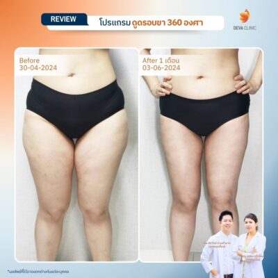 รวมรีวิวดูดไขมันต้นขา 13