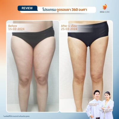 รวมรีวิวดูดไขมันต้นขา 8