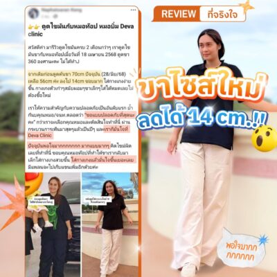 รวมรีวิวความประทับใจดูดไขมันต้นขา 5
