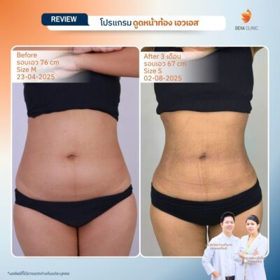 รีวิวดูดไขมันหน้าท้อง หน้าบริการ 2