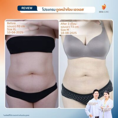 รีวิวดูดไขมันหน้าท้อง หน้าบริการ 5