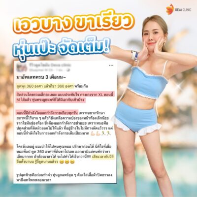 รวมรีวิวความประทับใจดูดไขมันต้นขา 3