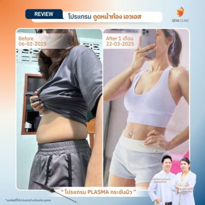 รีวิวดูดไขมันหน้าท้อง 9