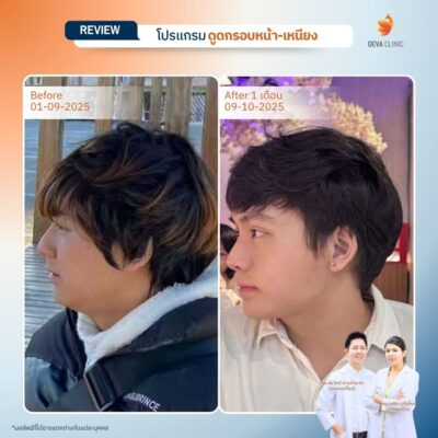 รีวิวดูดเหนียง กรอบหน้า 3