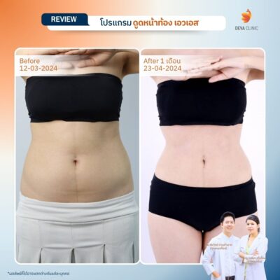 รีวิวดูดไขมันหน้าท้อง 10