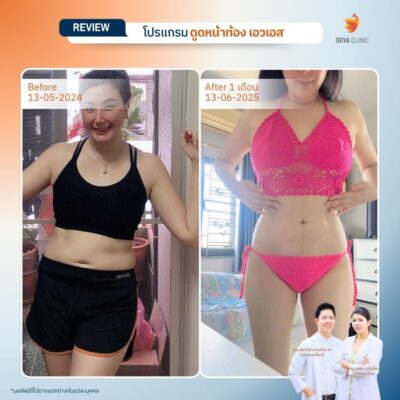 รีวิวดูดไขมันหน้าท้อง หน้าบริการ 1