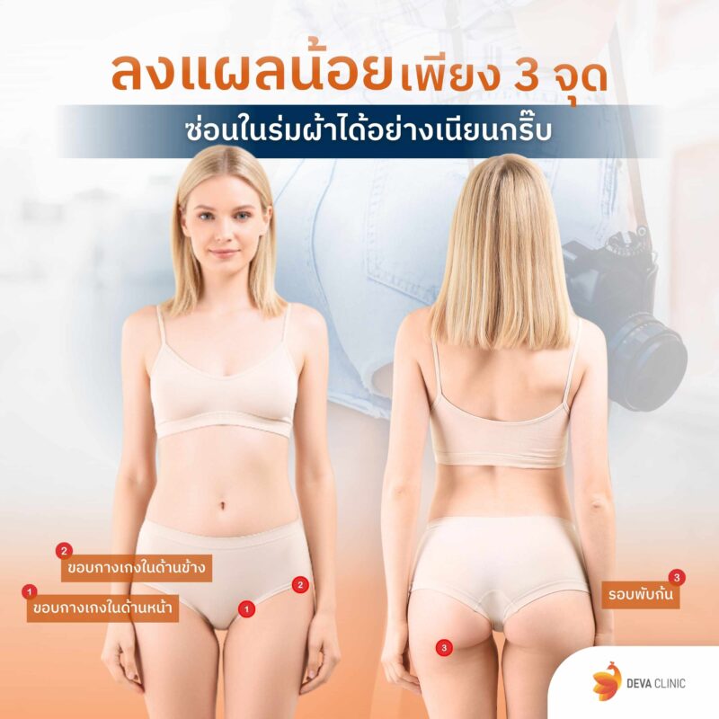 จุดลงแผลต้นขา ดูดไขมันต้นขา