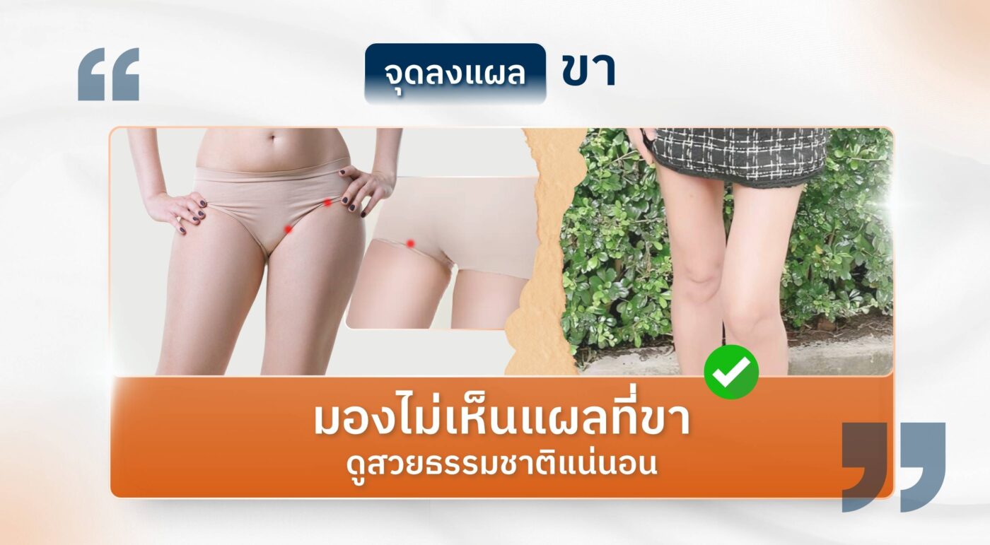 จุดลงแผลต้นขา