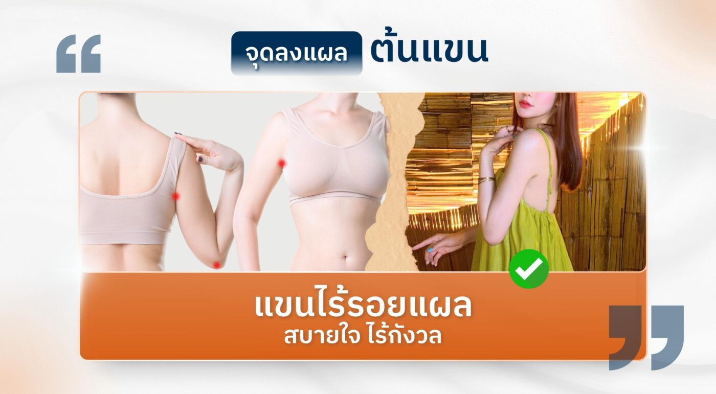 จุดลงแผลต้นแขน