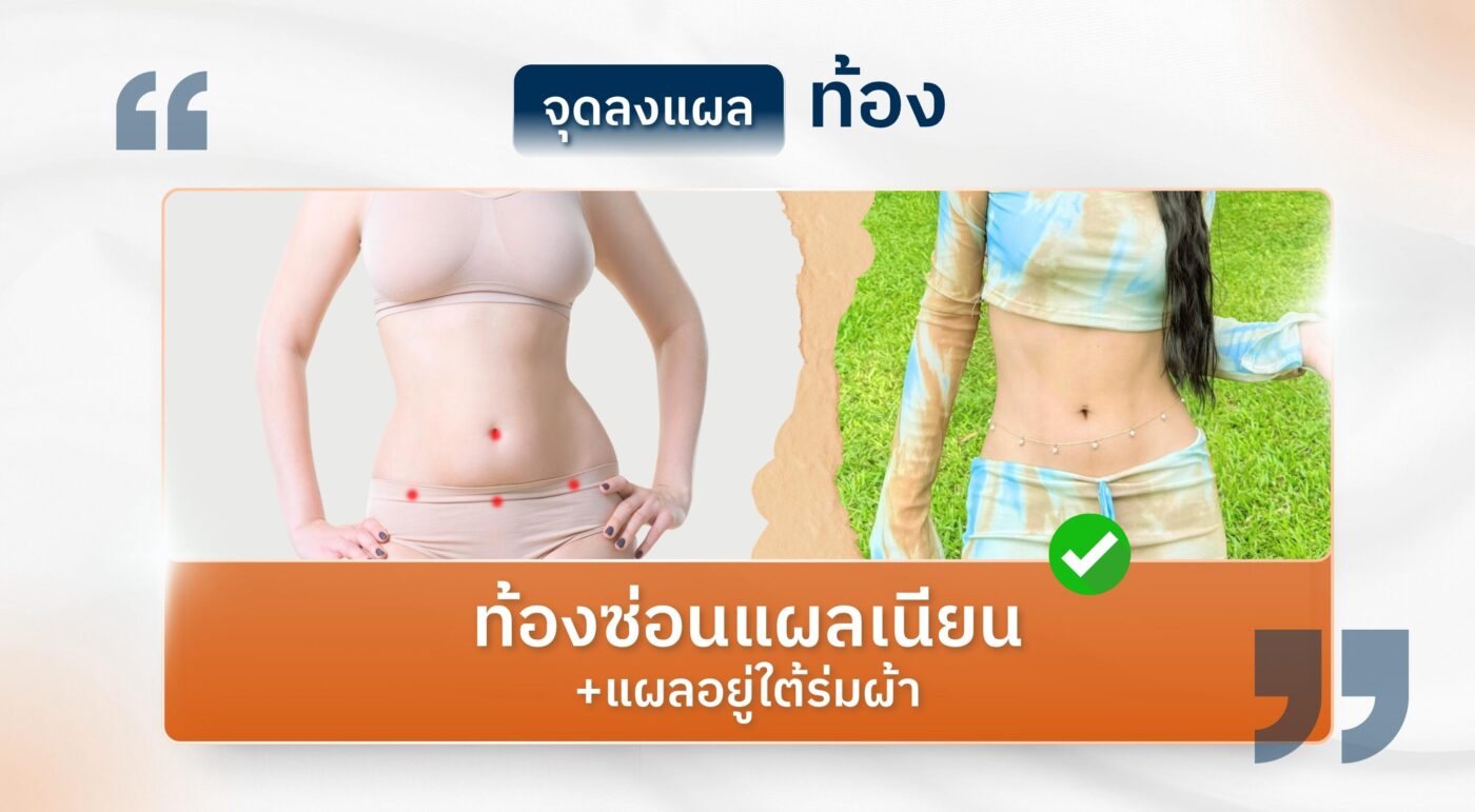 จุดลงแผลหน้าท้อง