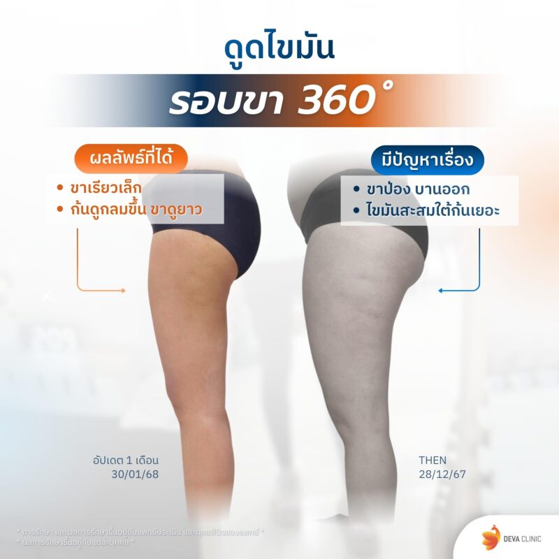 ดูดขา 360 องศา มุมข้าง