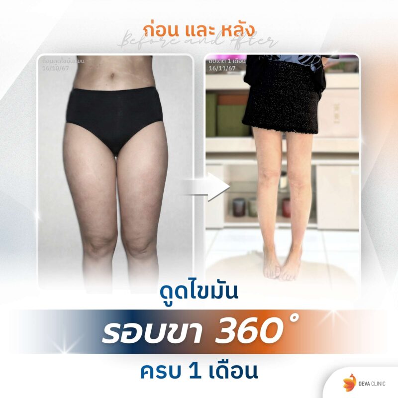 รีวิวก่อนหลังดูดไขมันต้นขา 360 องศา ไซส์ s-m