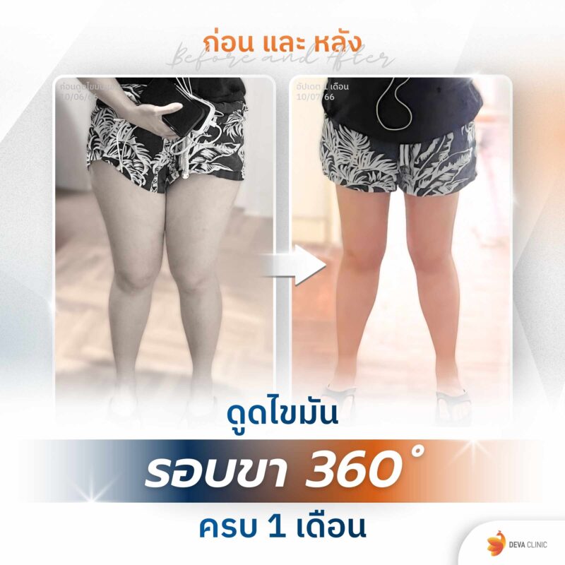 รีวิวก่อนหลังดูดไขมันต้นขา 360 องศา ไซส์ L-XL