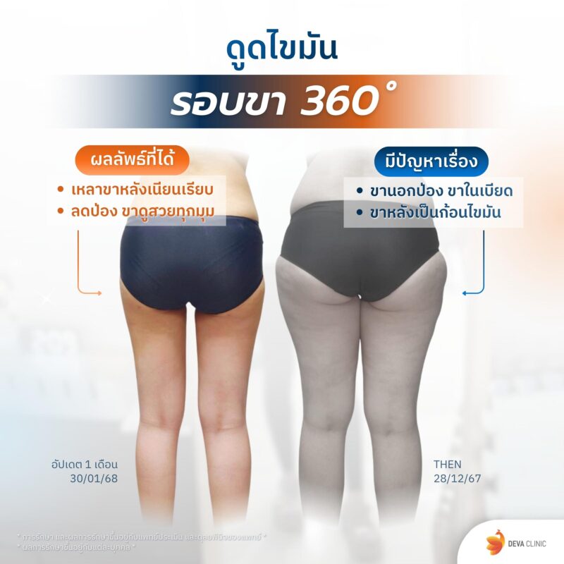 ดูดขา 360 องศา มุมหลัง