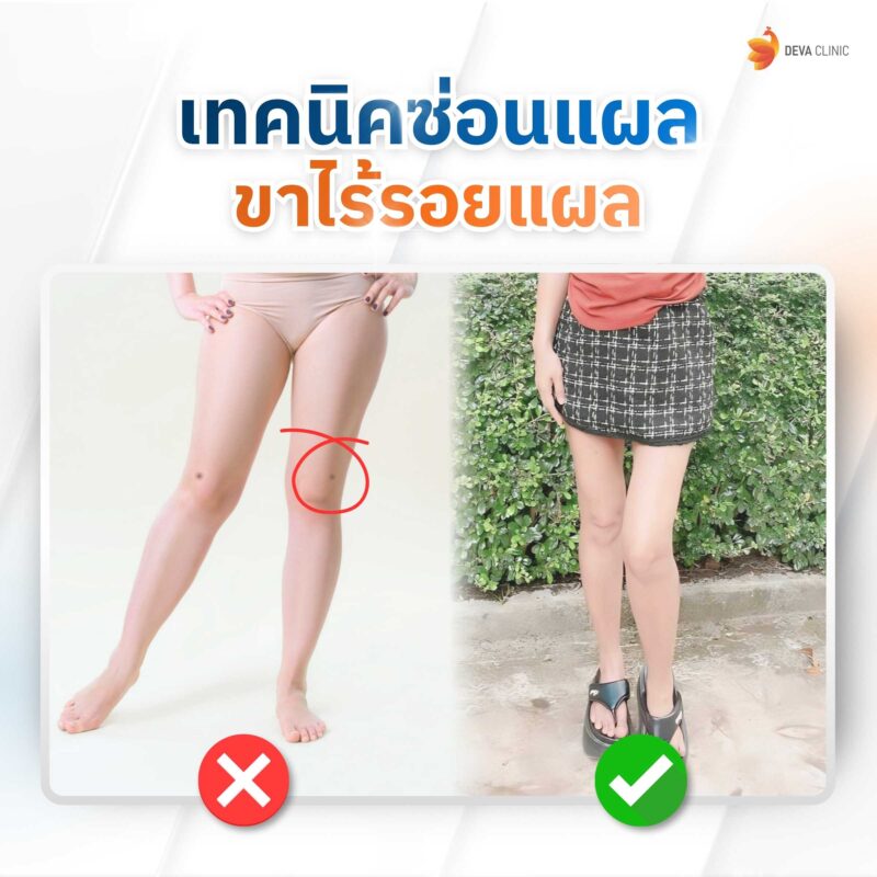 เทคนิคซ่อนแผล ต้นขา